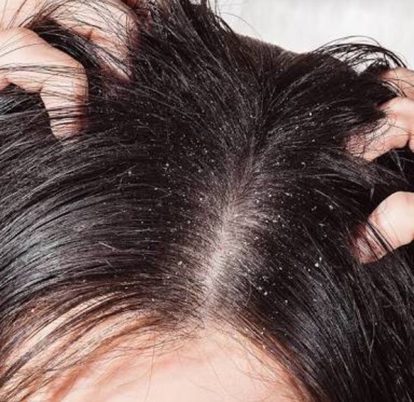 A Glimpse At Top Dandruff Shampoos For Sensitive Skin For Men And Women