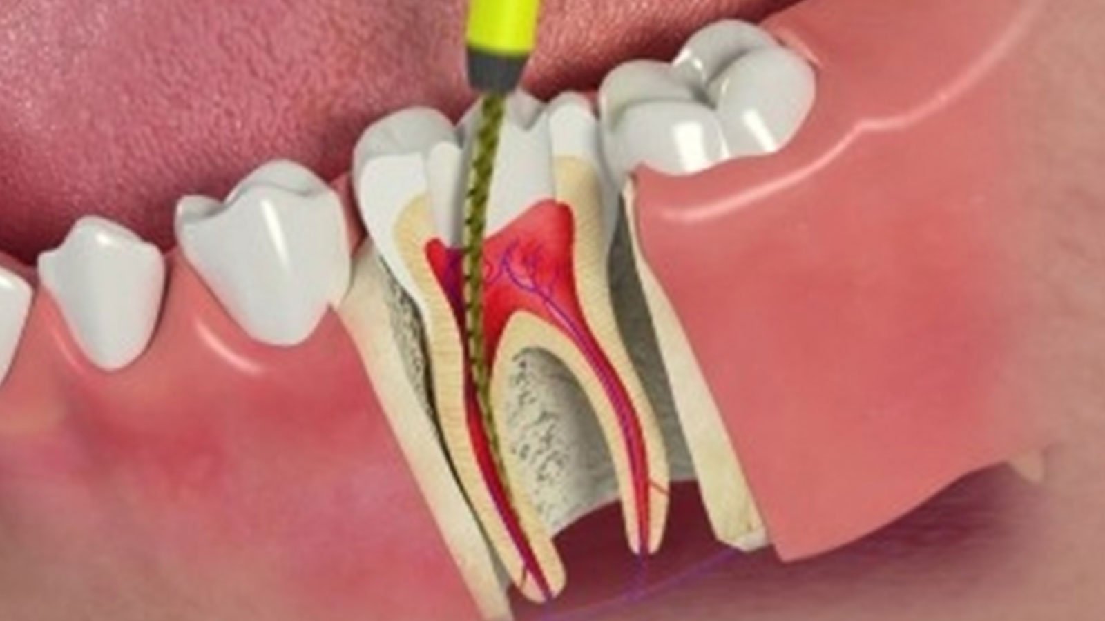 Benefits Of Root Canal Treatment