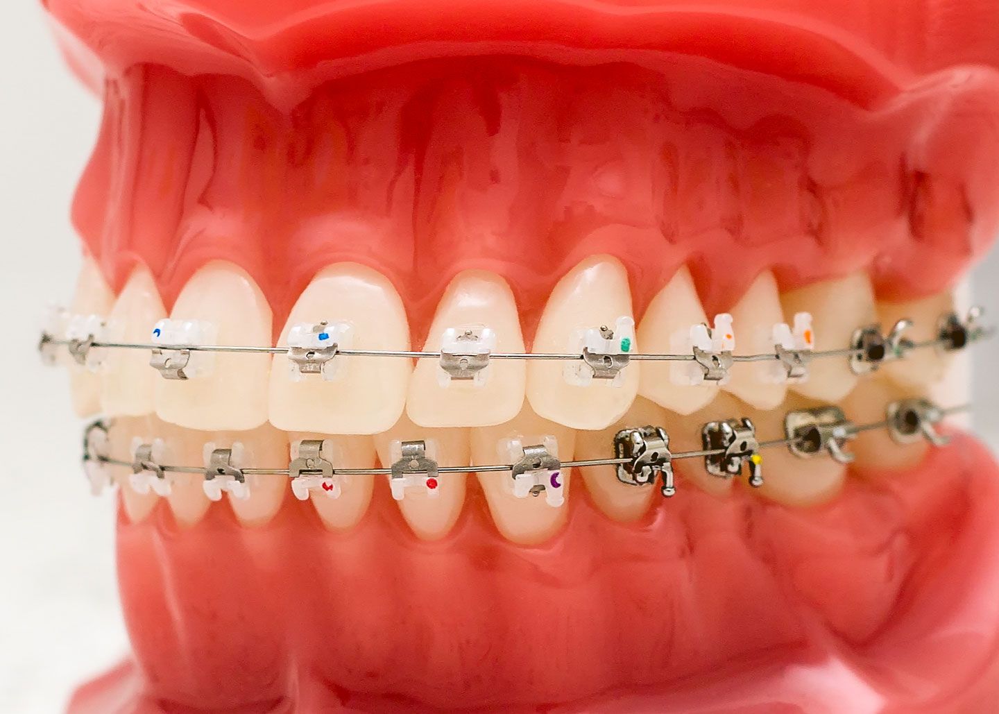 An Overview Of Invisalign Treatment Near Me