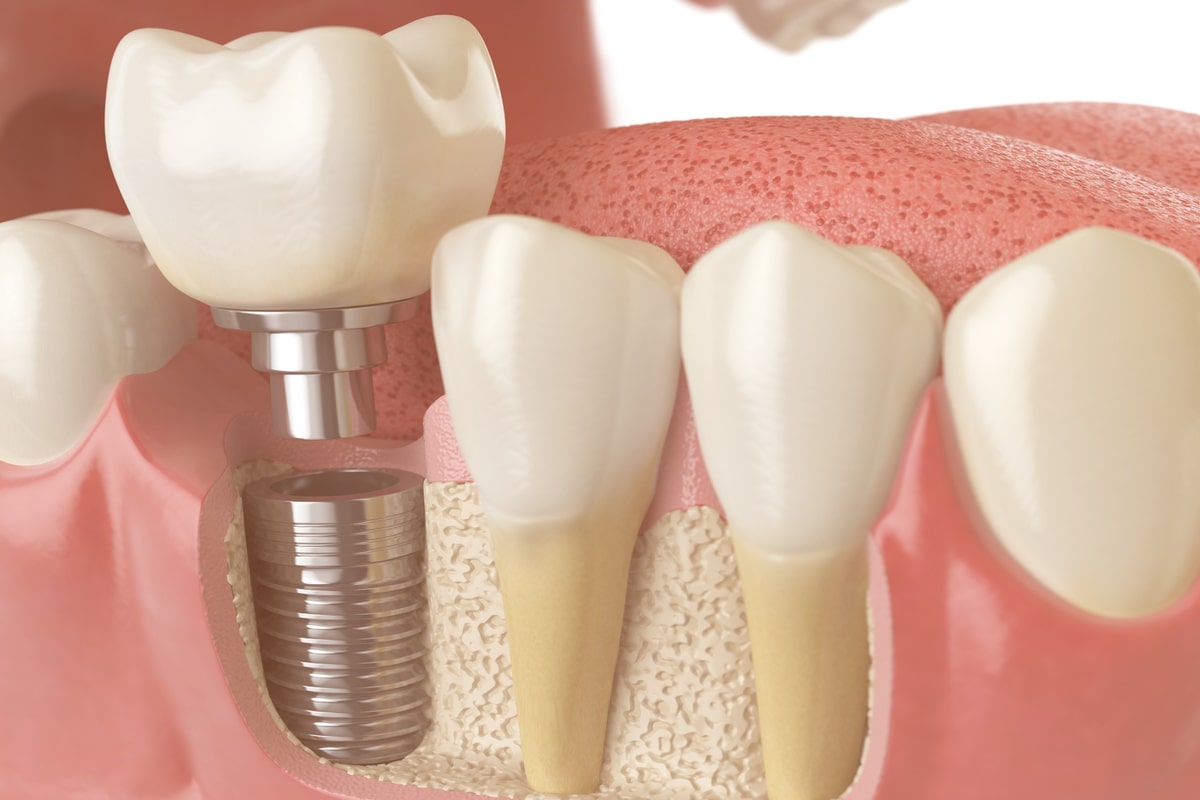 An Overview Of Affordable Dental Implants