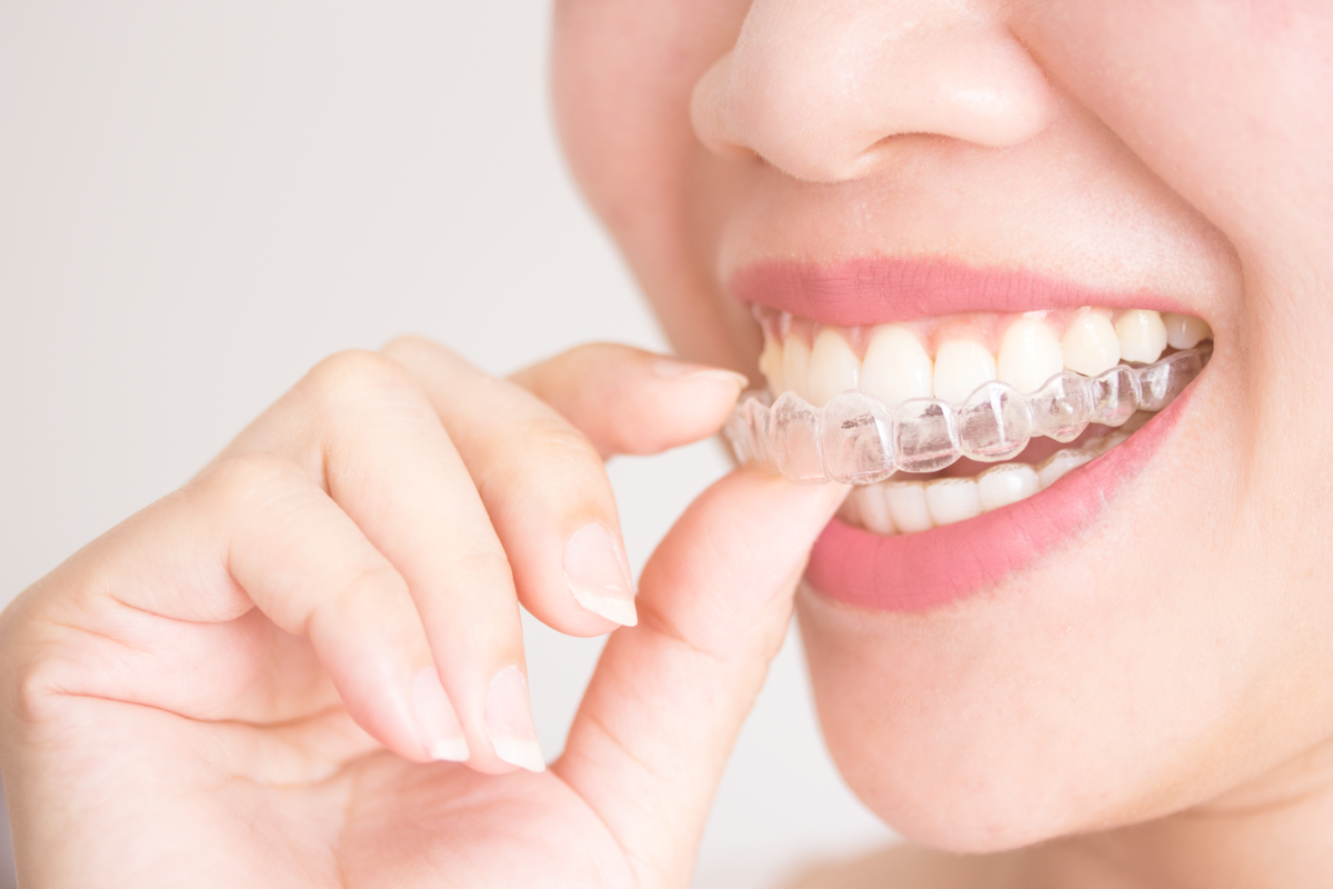 Detailed Analysis On The Invisalign Treatment Planning Service