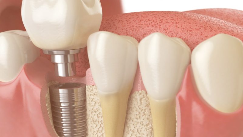 An Overview Of Affordable Dental Implants