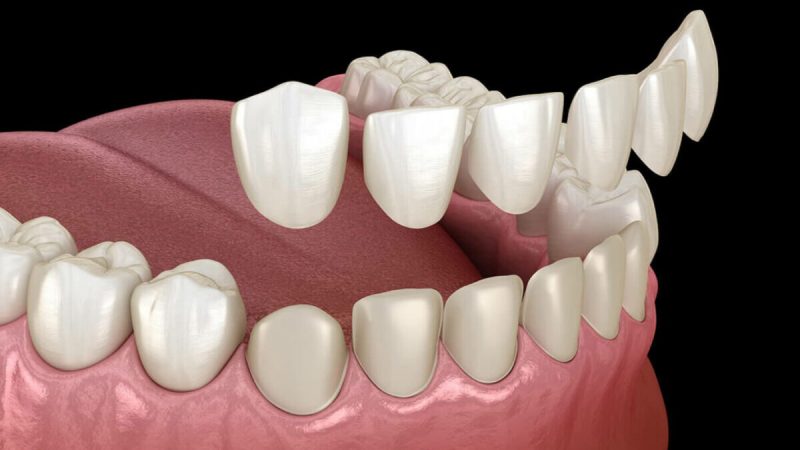 Dental Veneers – What You Should Know