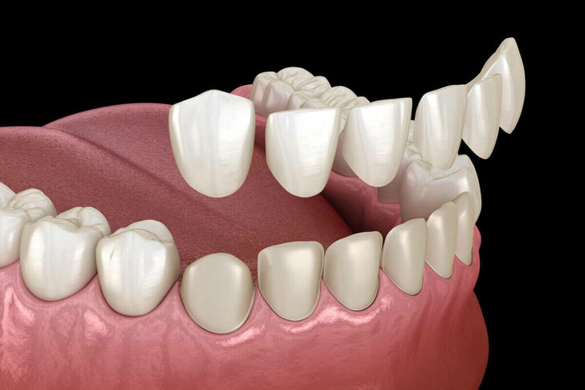 Dental Veneers – What You Should Know